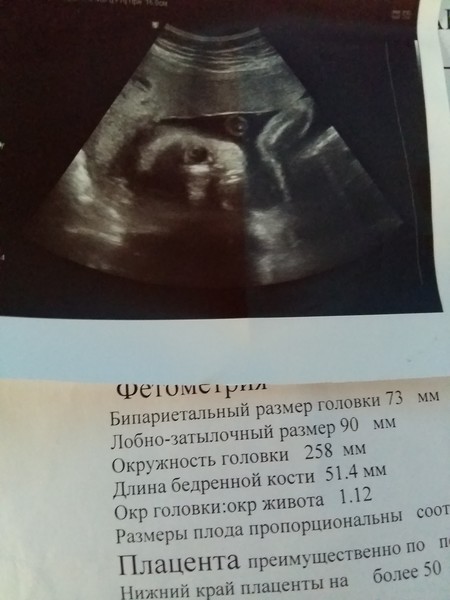 бипариетальный размер головы 21 неделя